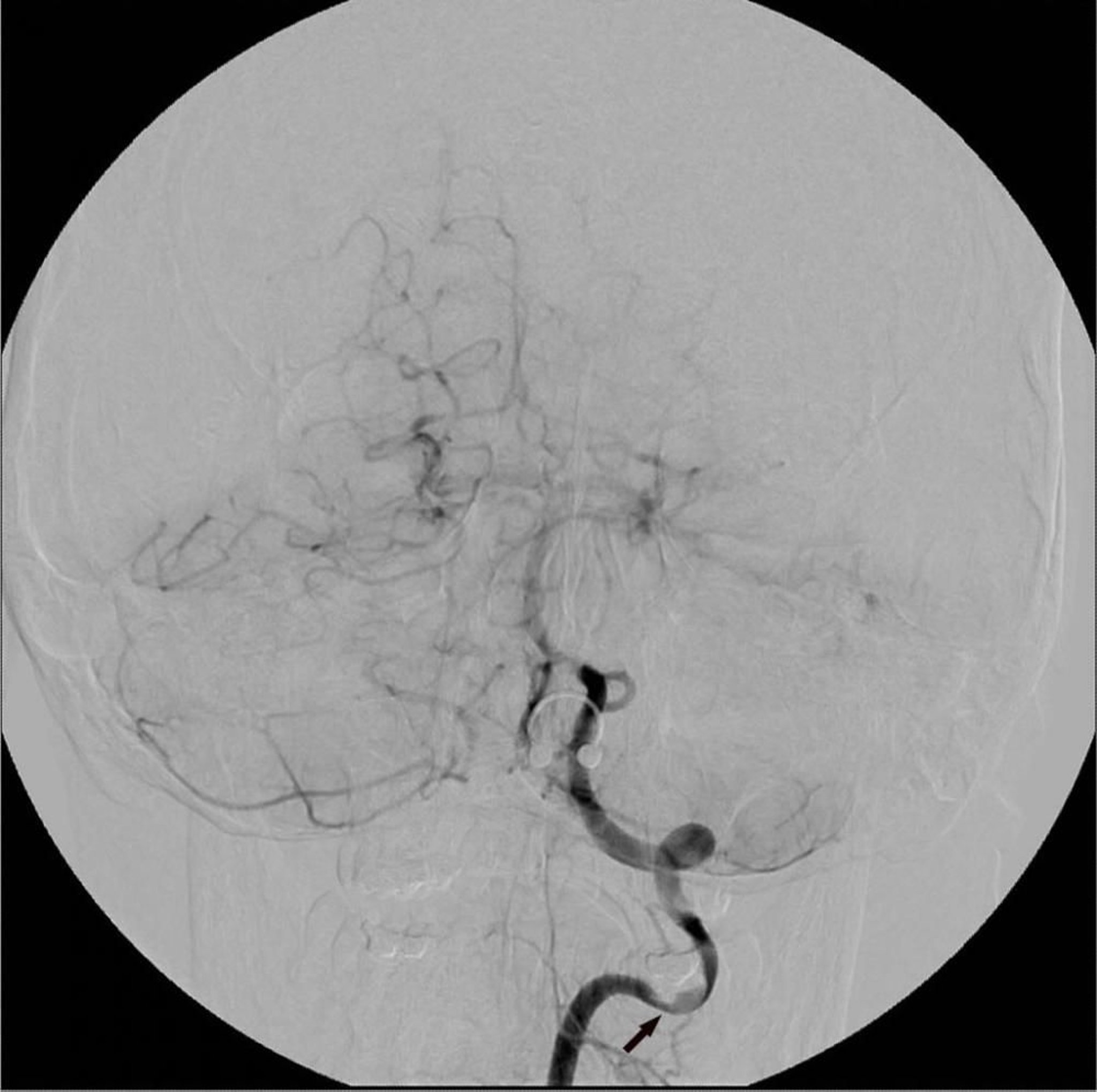 Digitale Subtraktionsangiographie