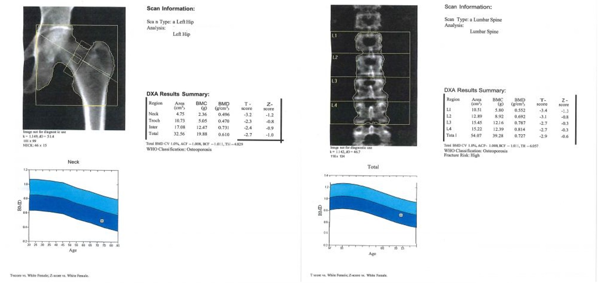 DXA scan