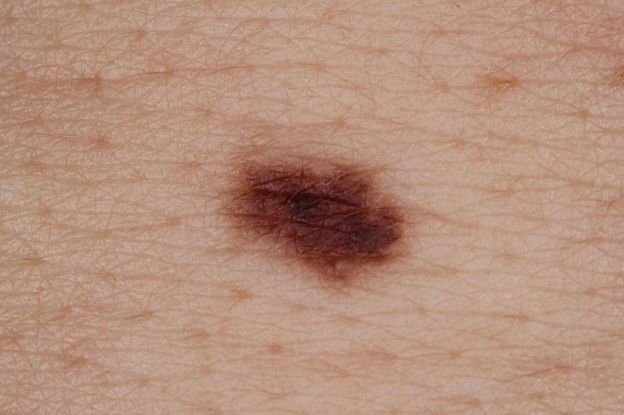 Atypical Nevus