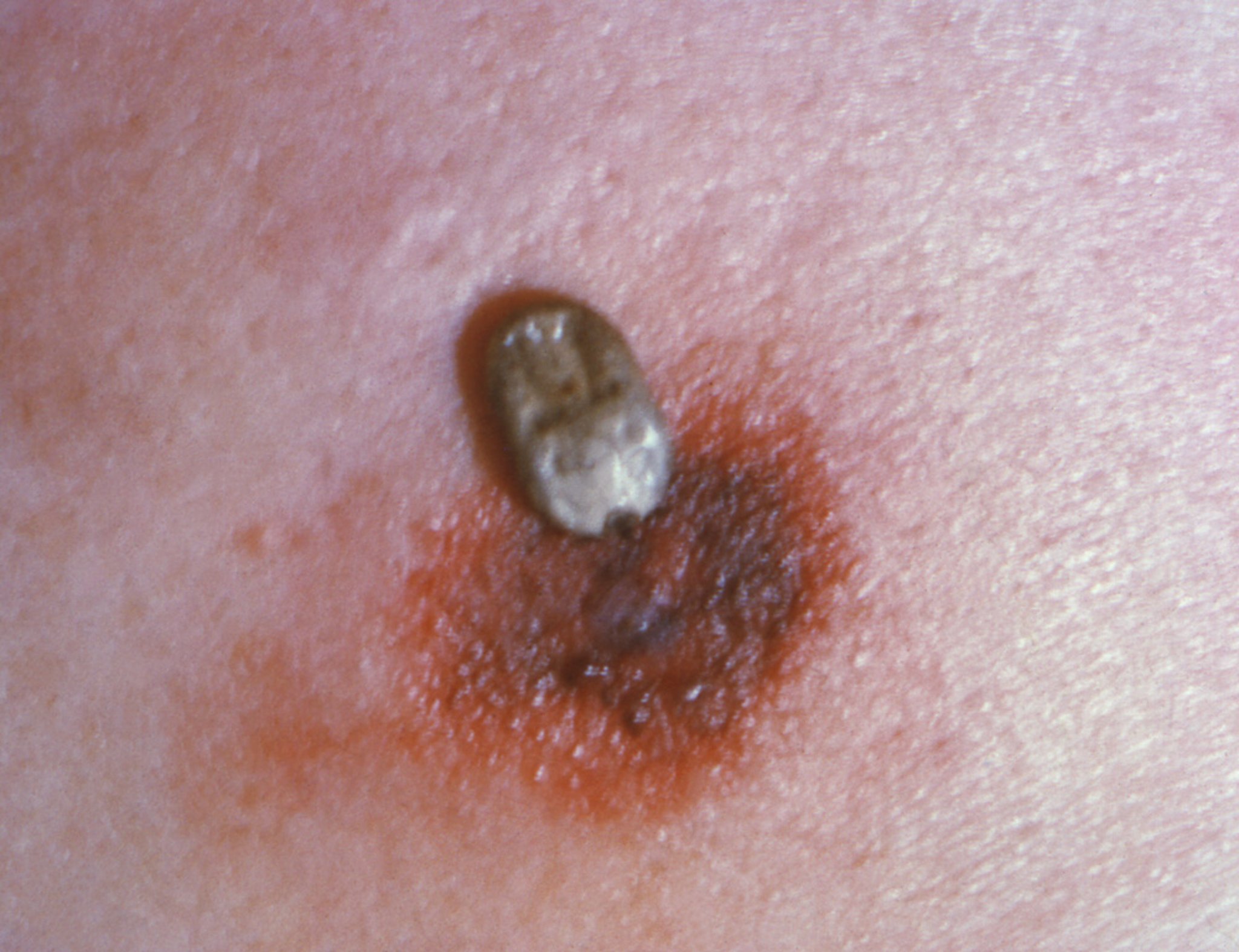 <i >Dermacentor andersoni</i> Bite