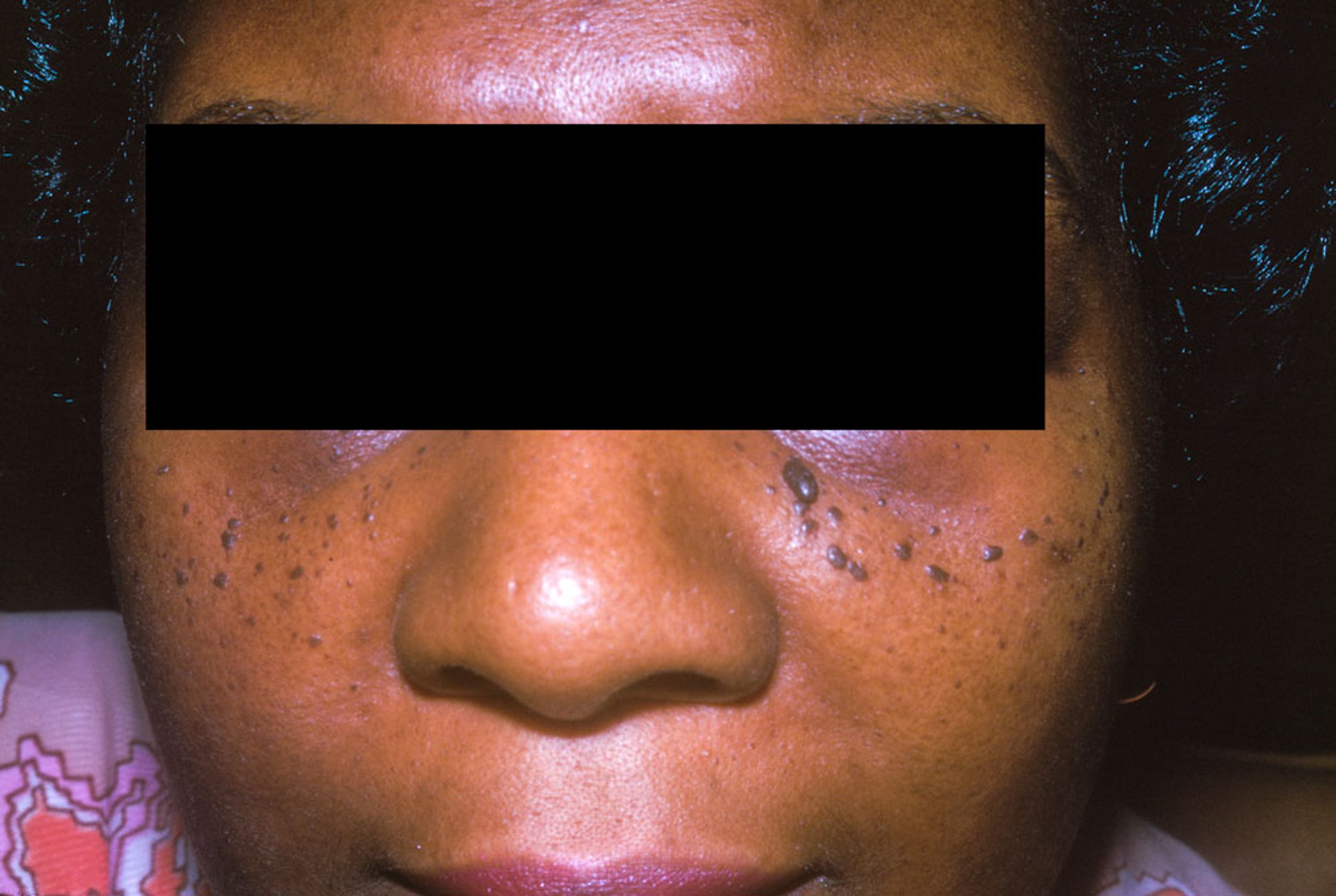 Dermatosis papulosa nigra (2)