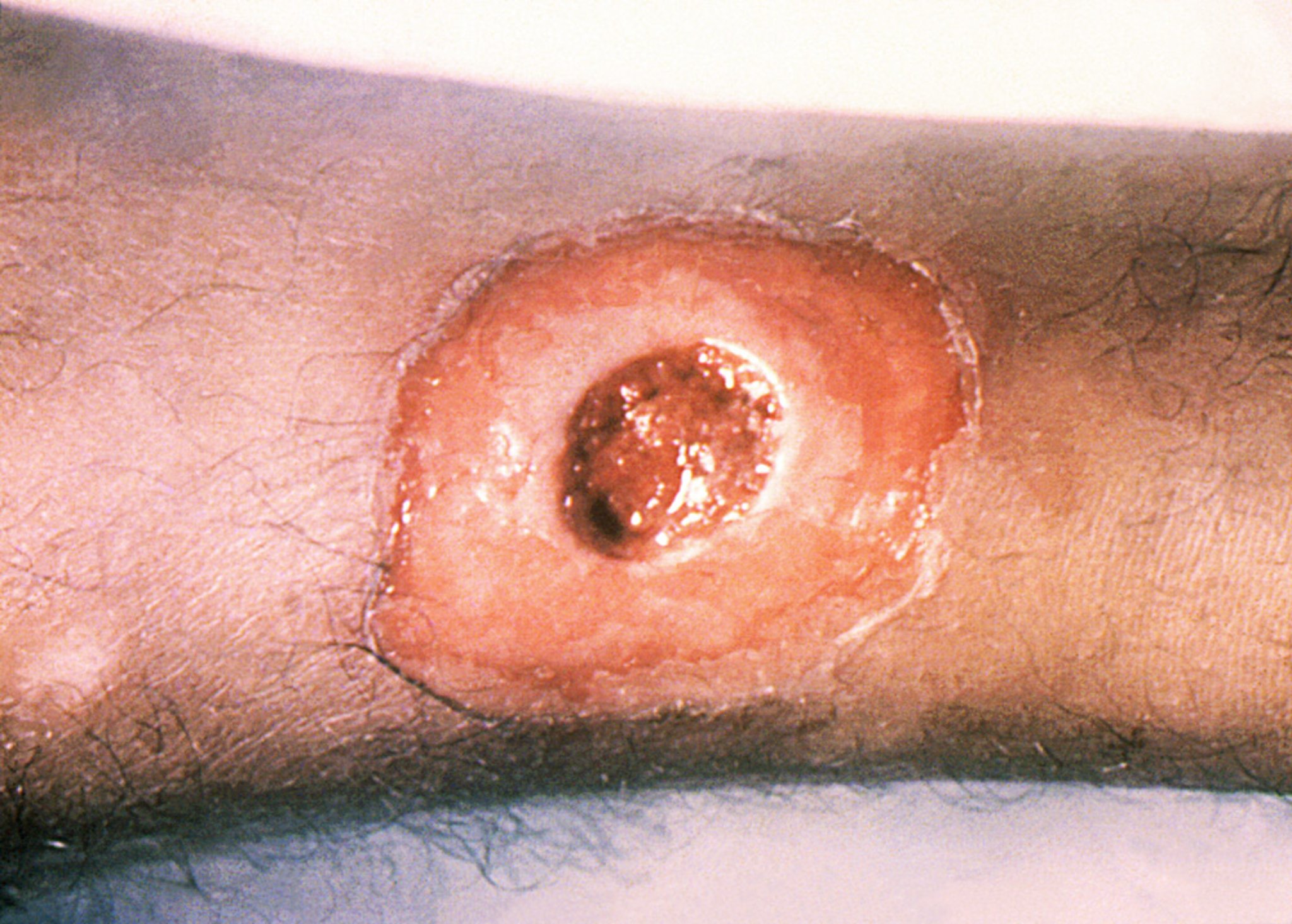 Central Ulceration