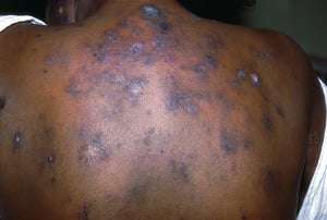 Discoid Lupus Erythematosus (1)