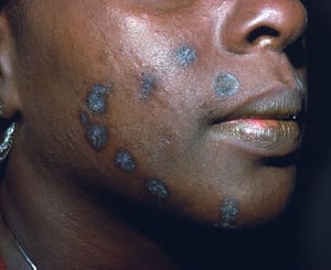 Discoid Lupus Erythematosus (3)