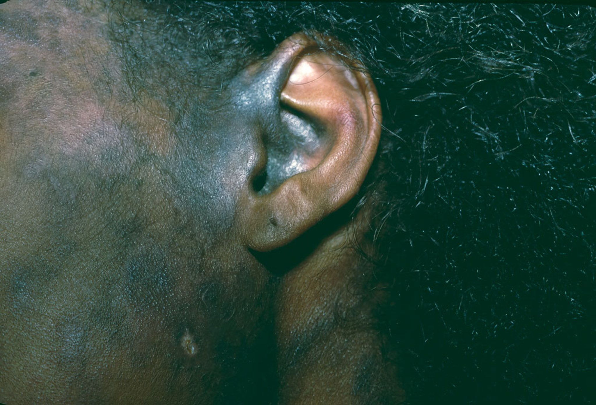 Diskoider Lupus erythematodes (4)