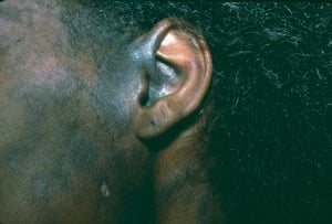 Lúpus eritematoso discoide (4)