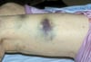 Ecchymoses dans la thrombopénie immunitaire