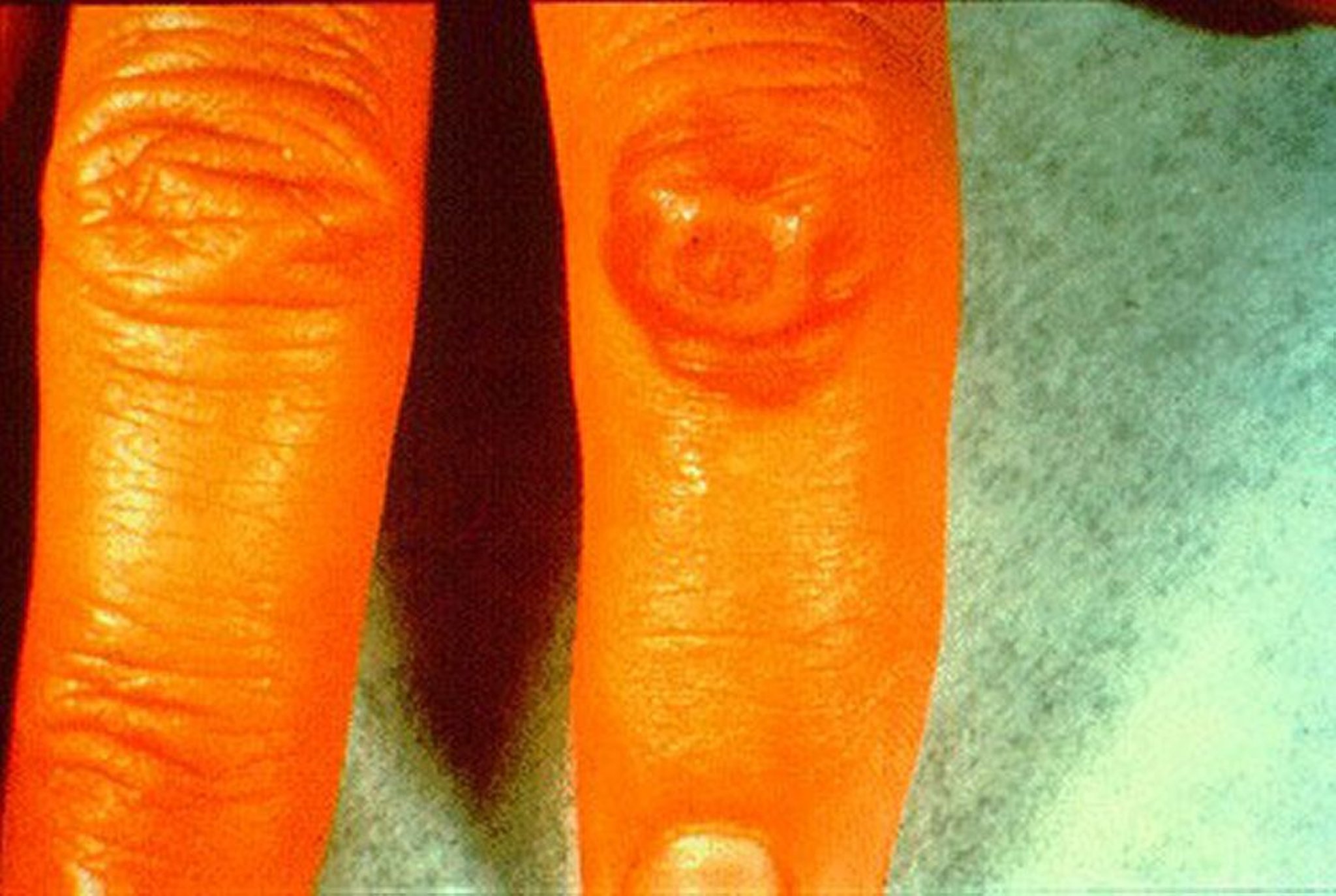 Ectima (contagioso)