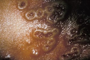 ワクシニア性湿疹