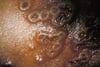 Eczema vaccinatum
