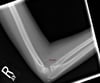 Lateral Radiograph of the Elbow
