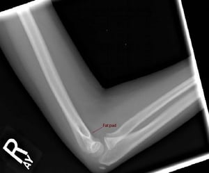 Рентгенівський знімок ліктя в бічній проекції