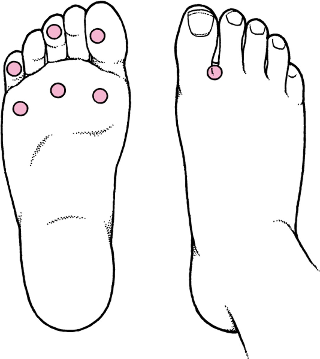 Diabetische Fußuntersuchung