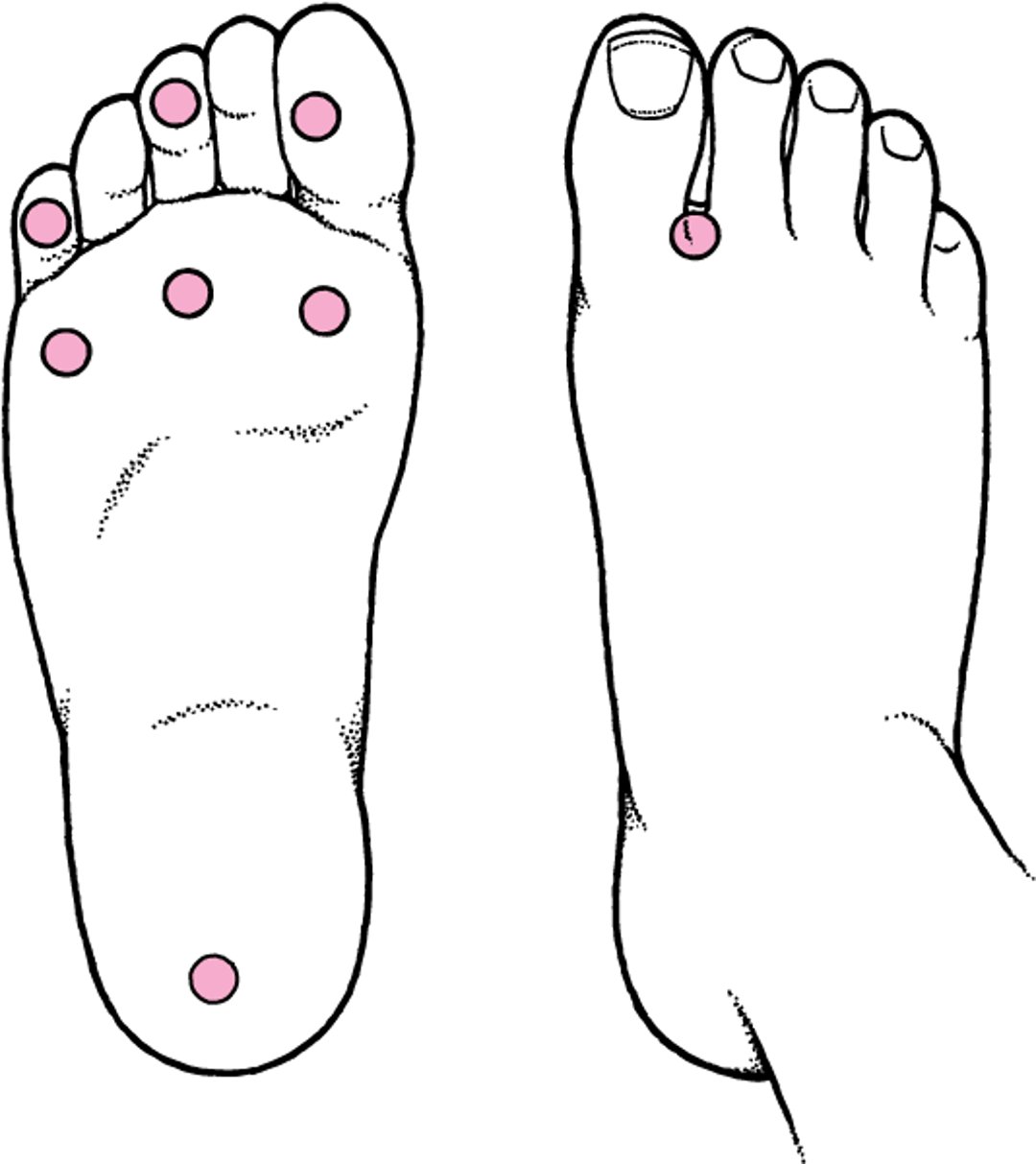 Pruebas de cribado para el pie diabético