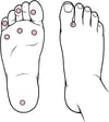 Dépistage du pied diabétique