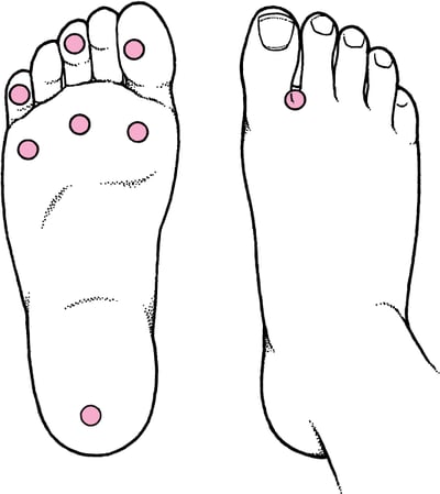 Dépistage du pied diabétique