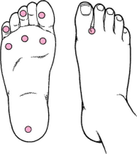 糖尿病患者の足のスクリーニング