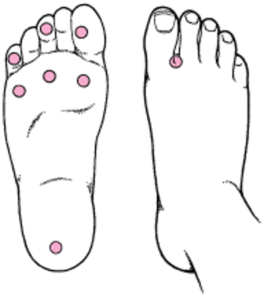 Скринінг на діабетичну стопу