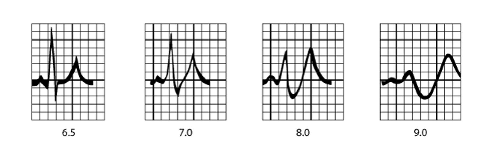 Image:ECG patterns in hyperkalemia-Merck Manual Professional Edition