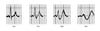 Patrones electrocardiográficos en la hiperpotasemia