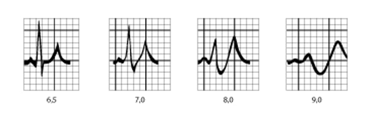 Dạng ECG trong tăng kali máu.