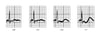ECG patterns in hypokalemia