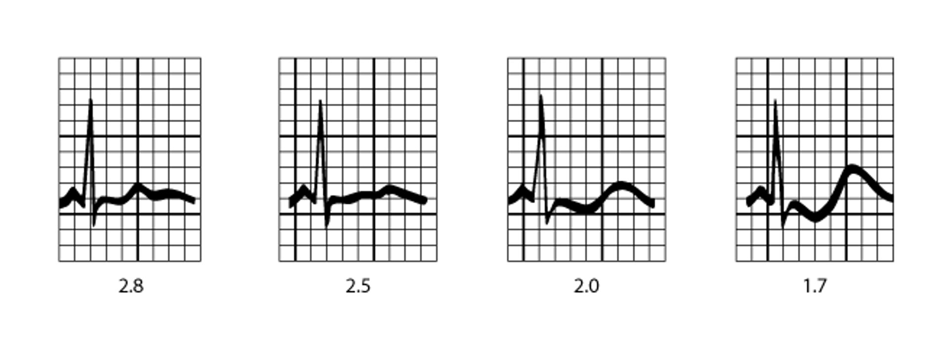 Image:ECG patterns in hypokalemia-Merck Manual Professional Edition