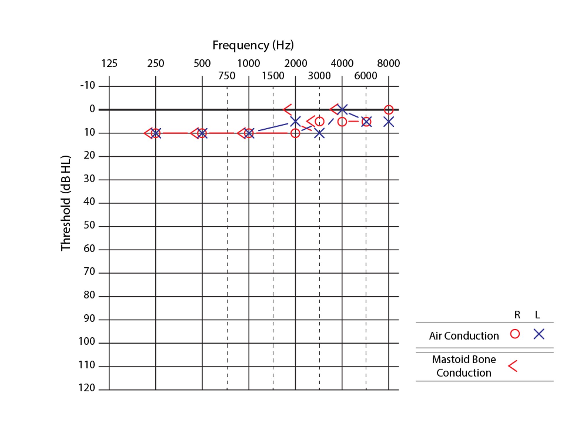 Audiogram of Right Ear in a Patient with Normal Hearing