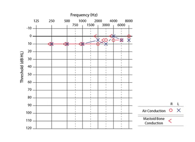 Audiogram of Right Ear in a Patient with Normal Hearing