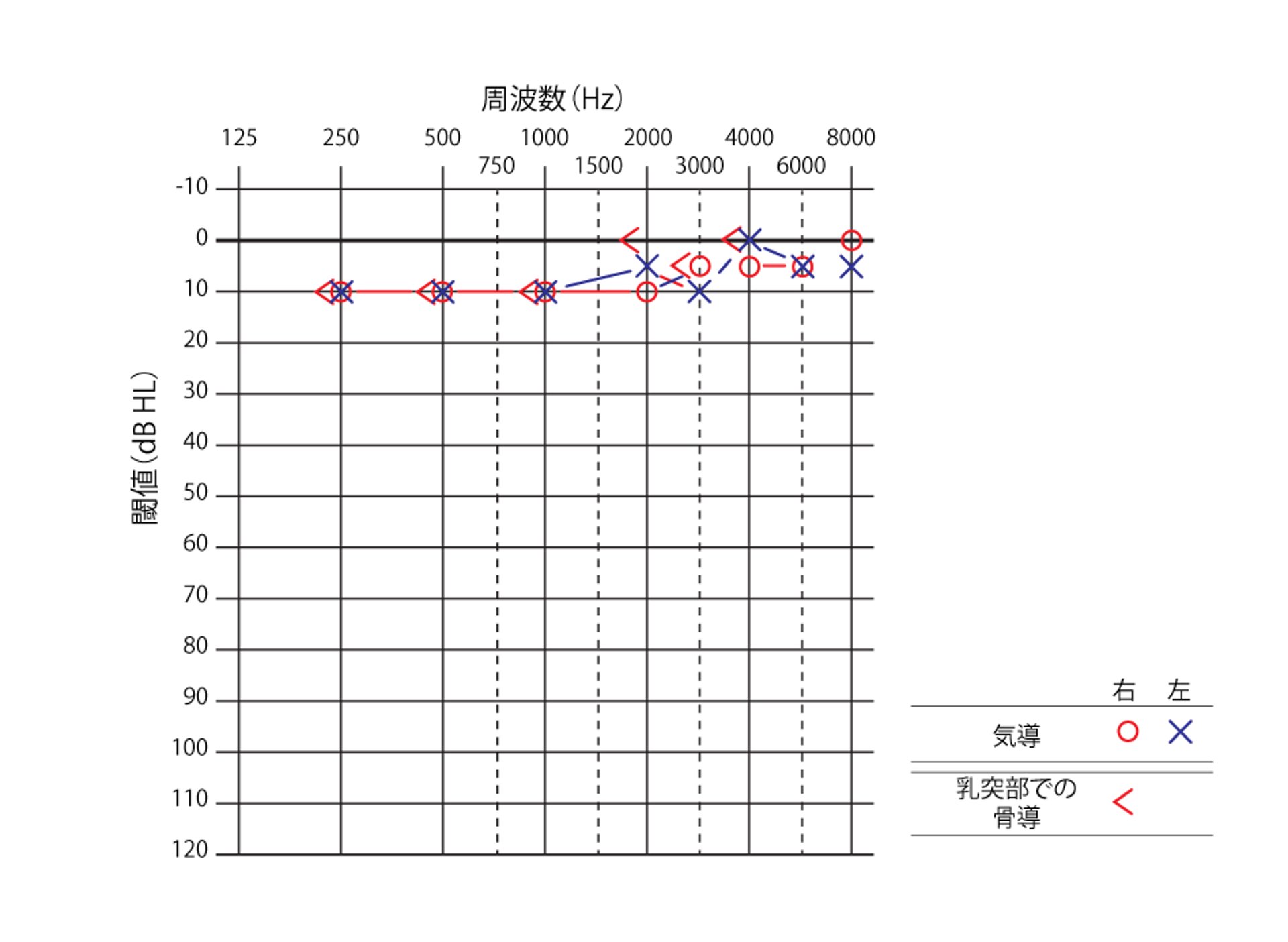 聴力が正常な患者の右耳のオージオグラム