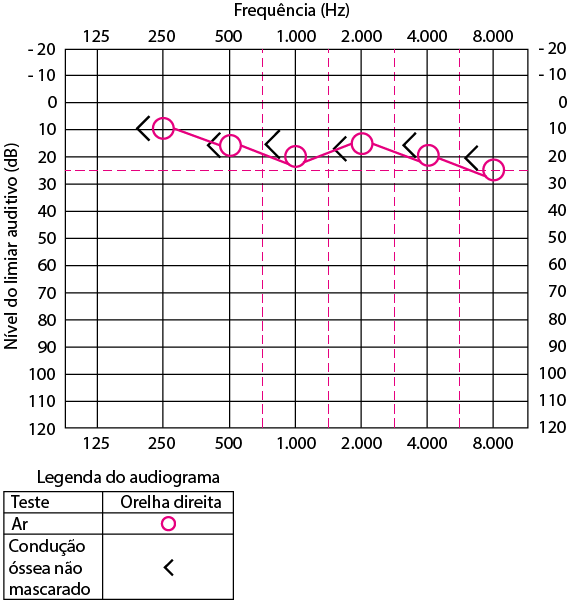audiograma perda auditiva condutiva
