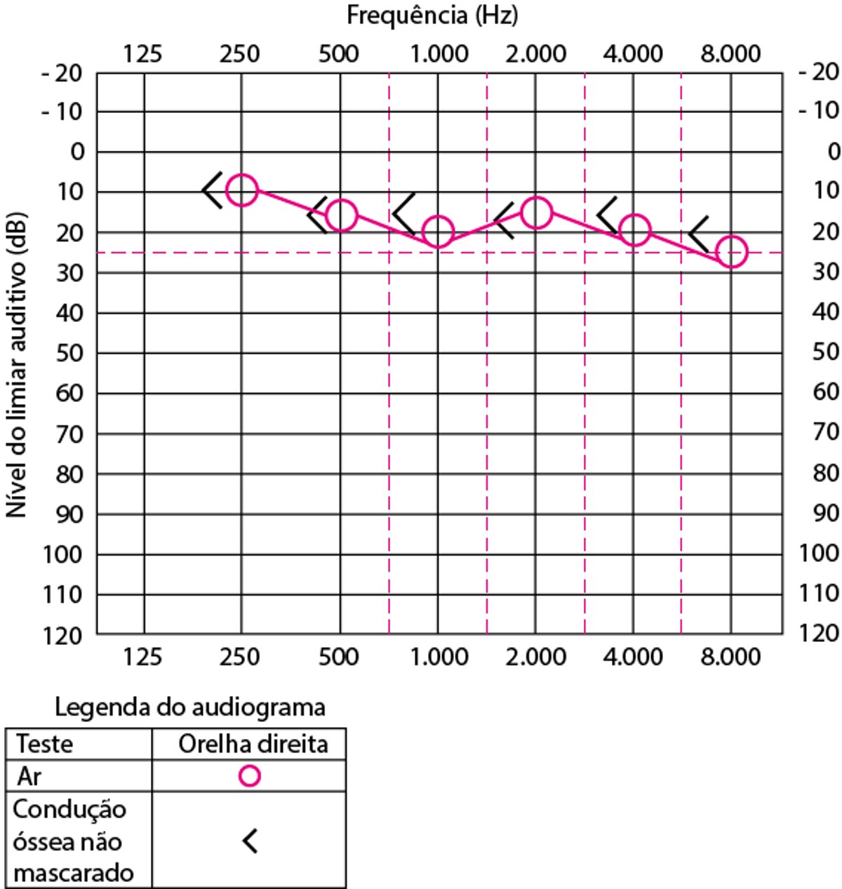 Audiograma da orelha direita em paciente com audição normal