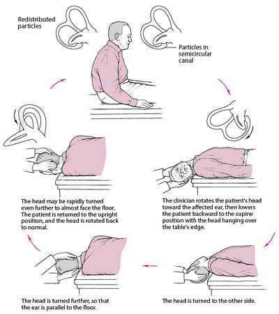 Epley maneuver: A Simple Treatment for a Common Cause of Vertigo