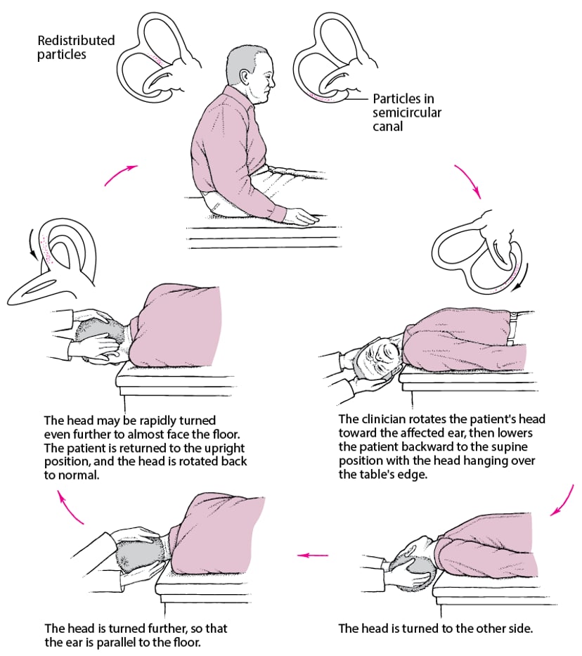 Image:Epley maneuver: A Simple Treatment for a Common Cause of Vertigo ...