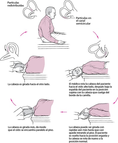 Maniobra de Epley: un tratamiento simple para una causa común de vértigo