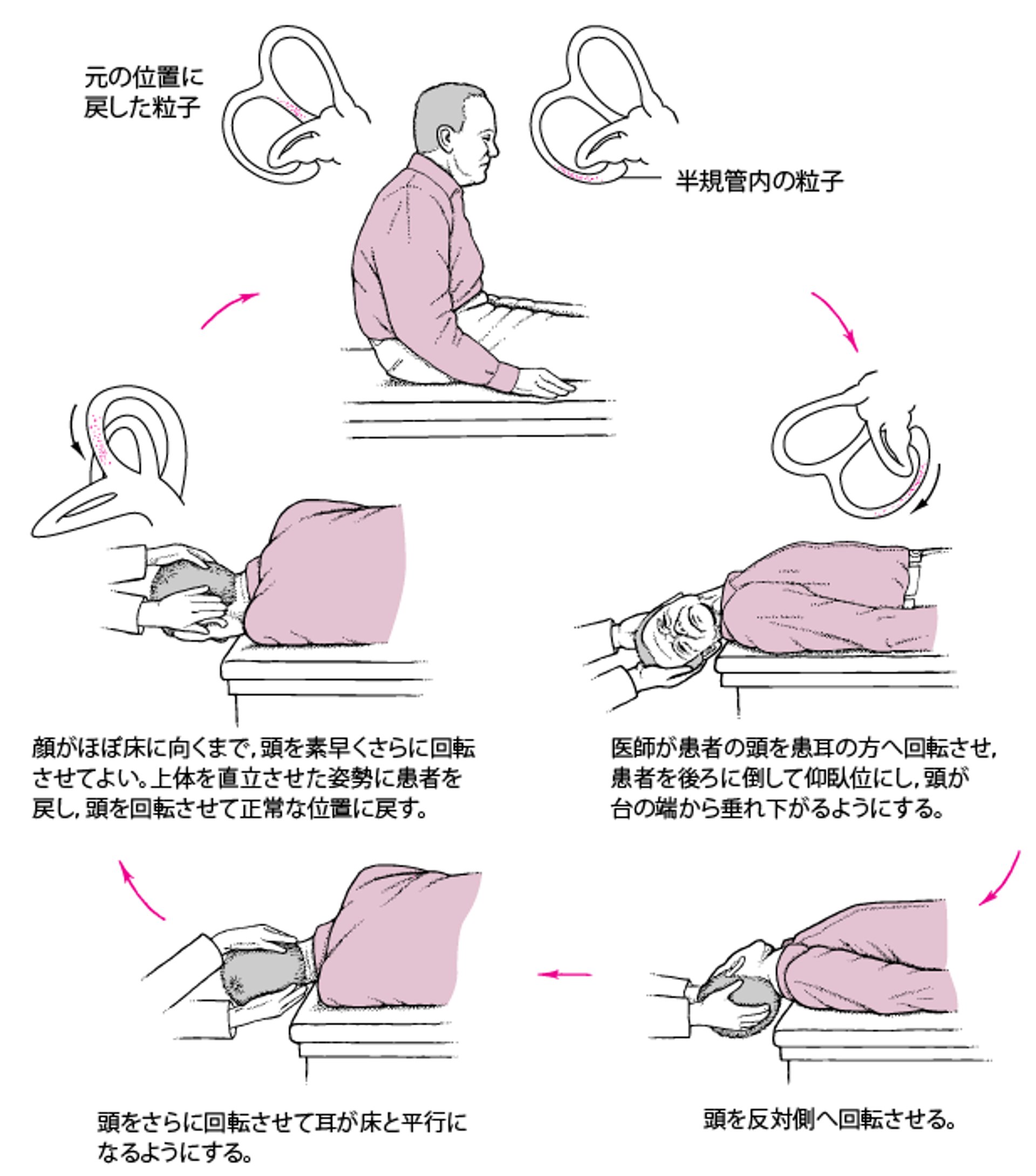 Epley法：回転性めまいの一般的な原因に対する単純な治療法