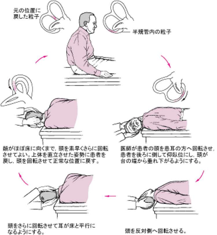Epley法：回転性めまいの一般的な原因に対する単純な治療法