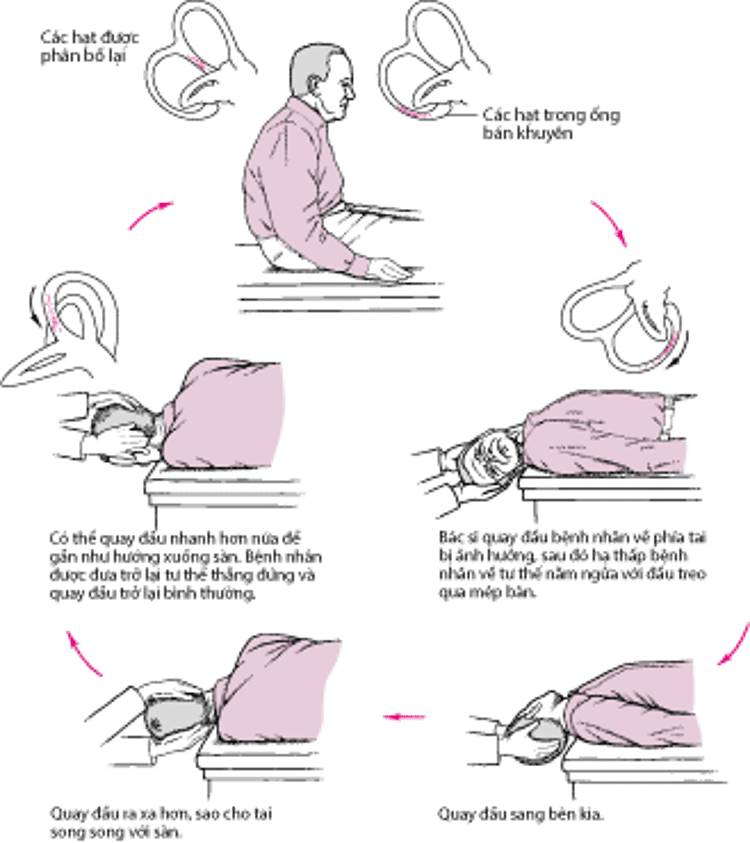 Nghiệm pháp Epley: Một phương pháp điều trị đơn giản cho một nguyên nhân phổ biến gây chóng mặt