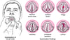 Laryngeal disorders