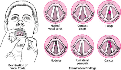 Laryngeal disorders