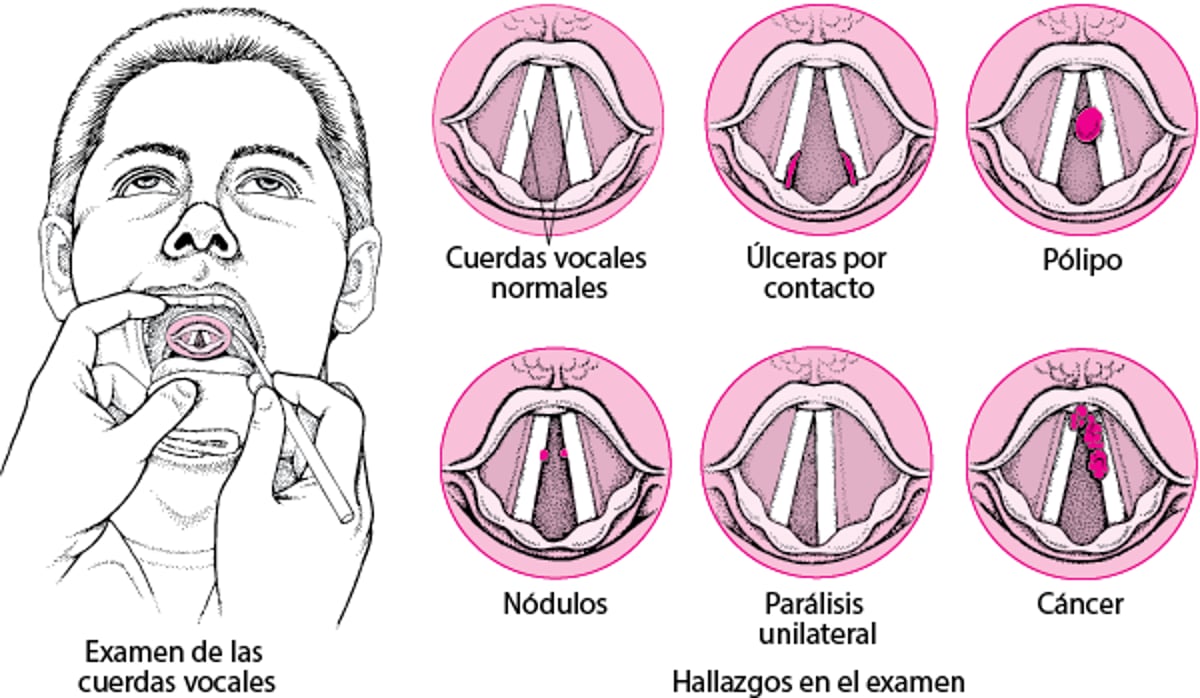 Trastornos de la laringe