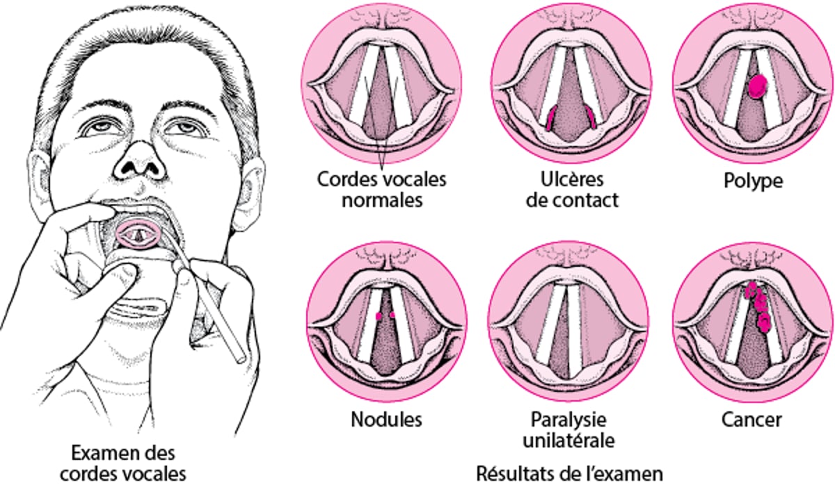 Troubles laryngiens