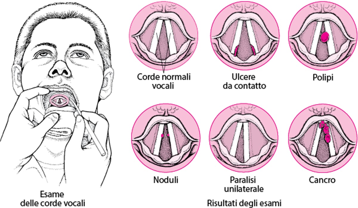 Disturbi della laringe