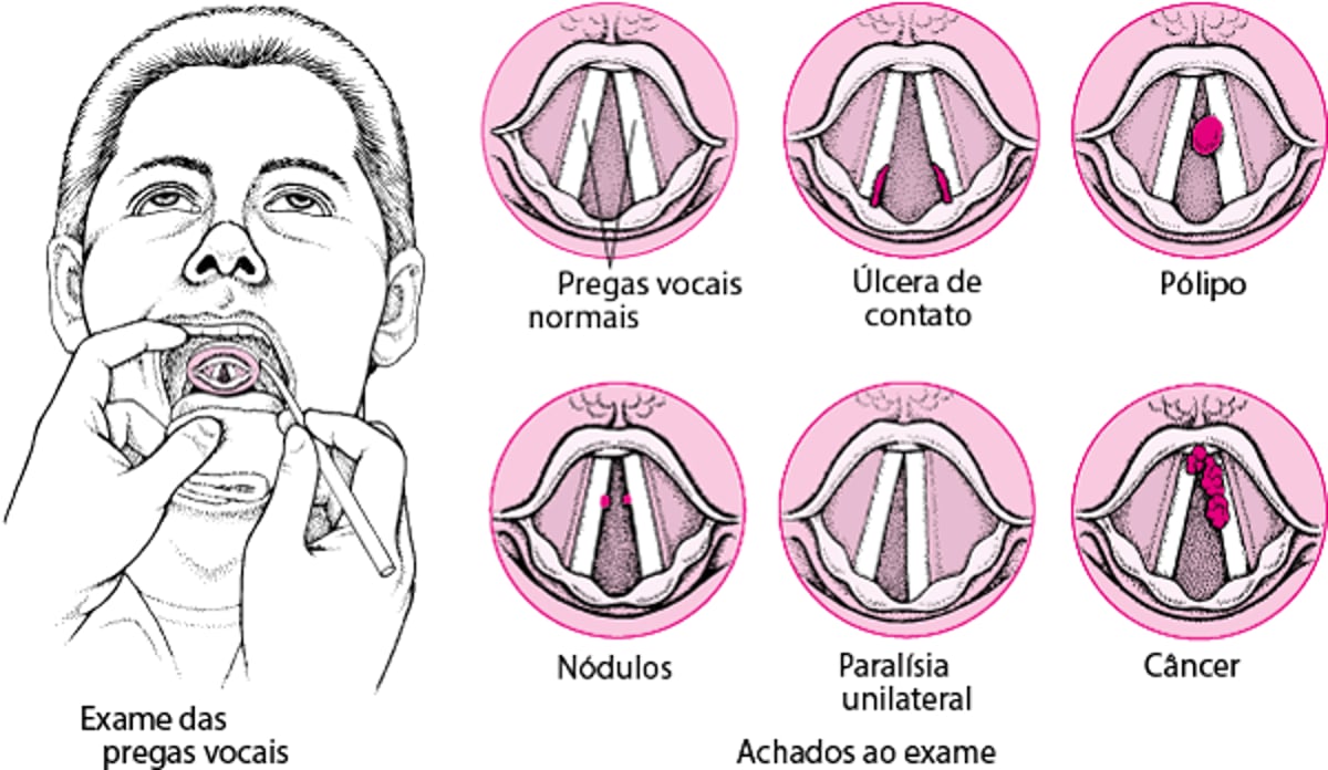 Distúrbios laríngeos