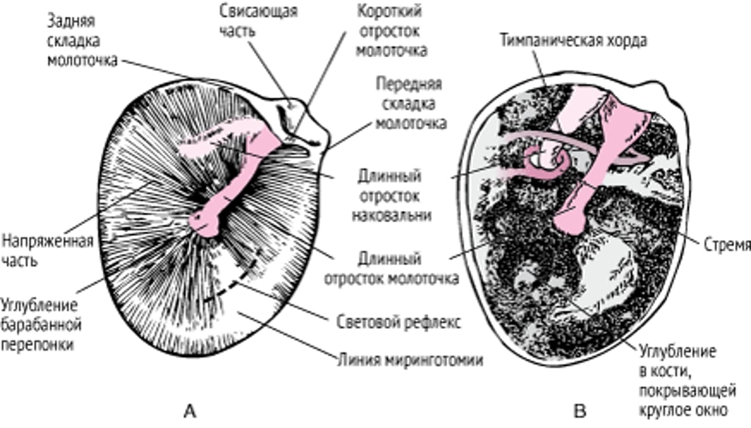 Барабаннаая перепонка правого уха; барабанная полость с удаленной барабанной перепонкой