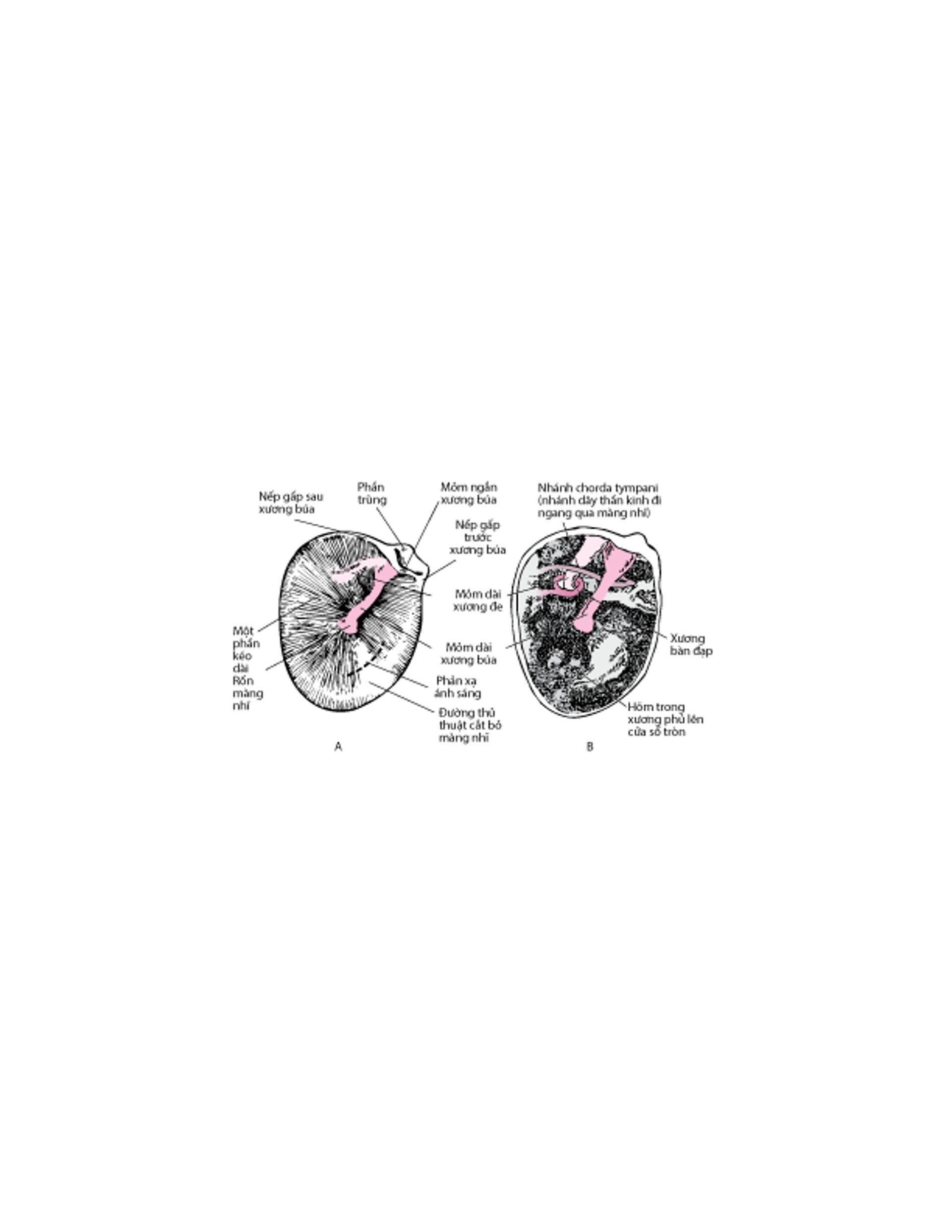 Màng nhĩ tai phải (A); Khoang nhĩ đã được cắt bỏ màng nhĩ (B)