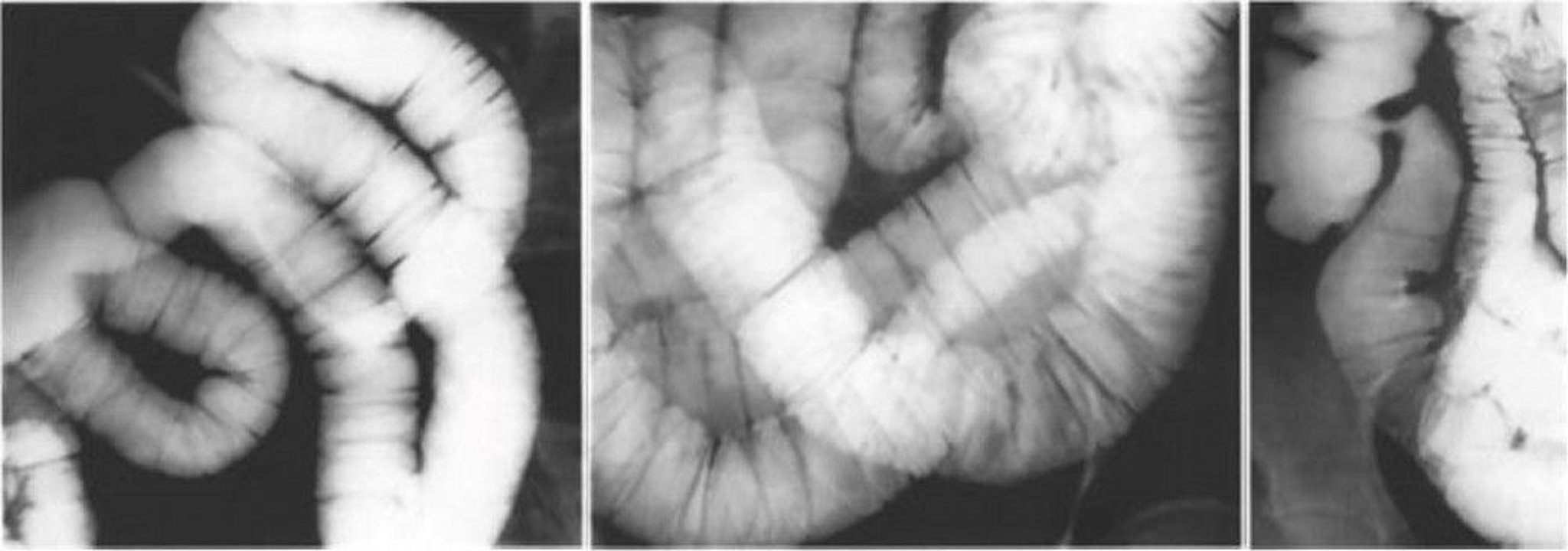 Enteroclysis Showing Normal Anatomy