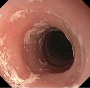 Exudados en la esofagitis eosinofílica