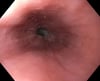 Furrows in Eosinophilic Esophagitis
