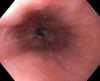 Surcos en la esofagitis eosinofílica
